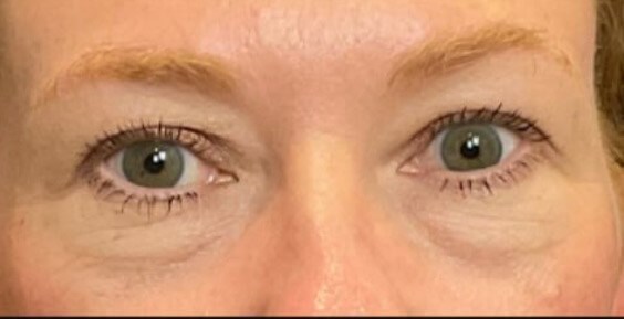 Upper & Lower Blepharoplasty Before