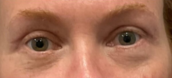 Upper & Lower Blepharoplasty After