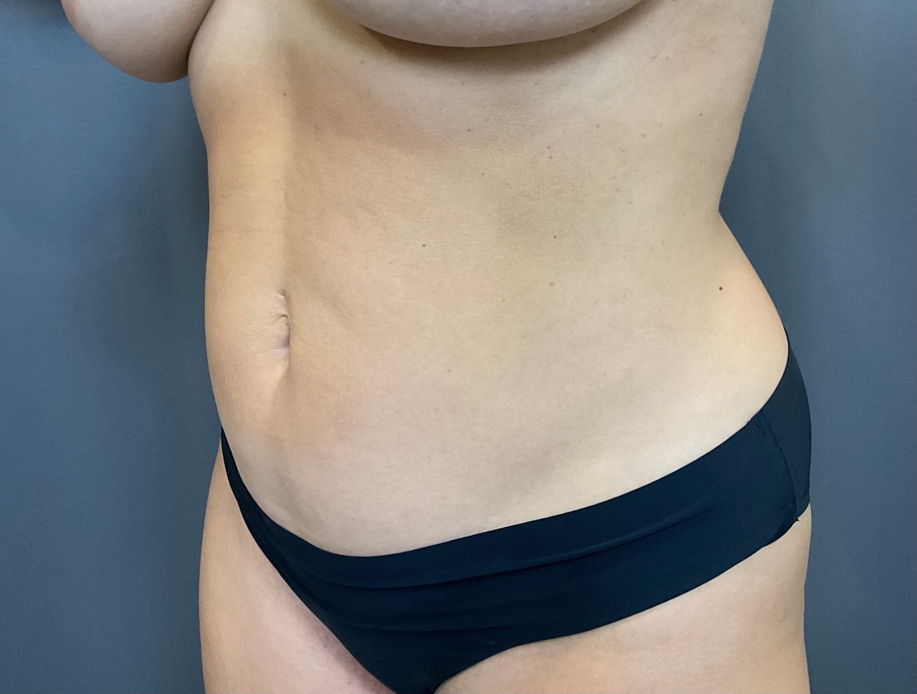 Liposuction of Abdomen,Flanks Before