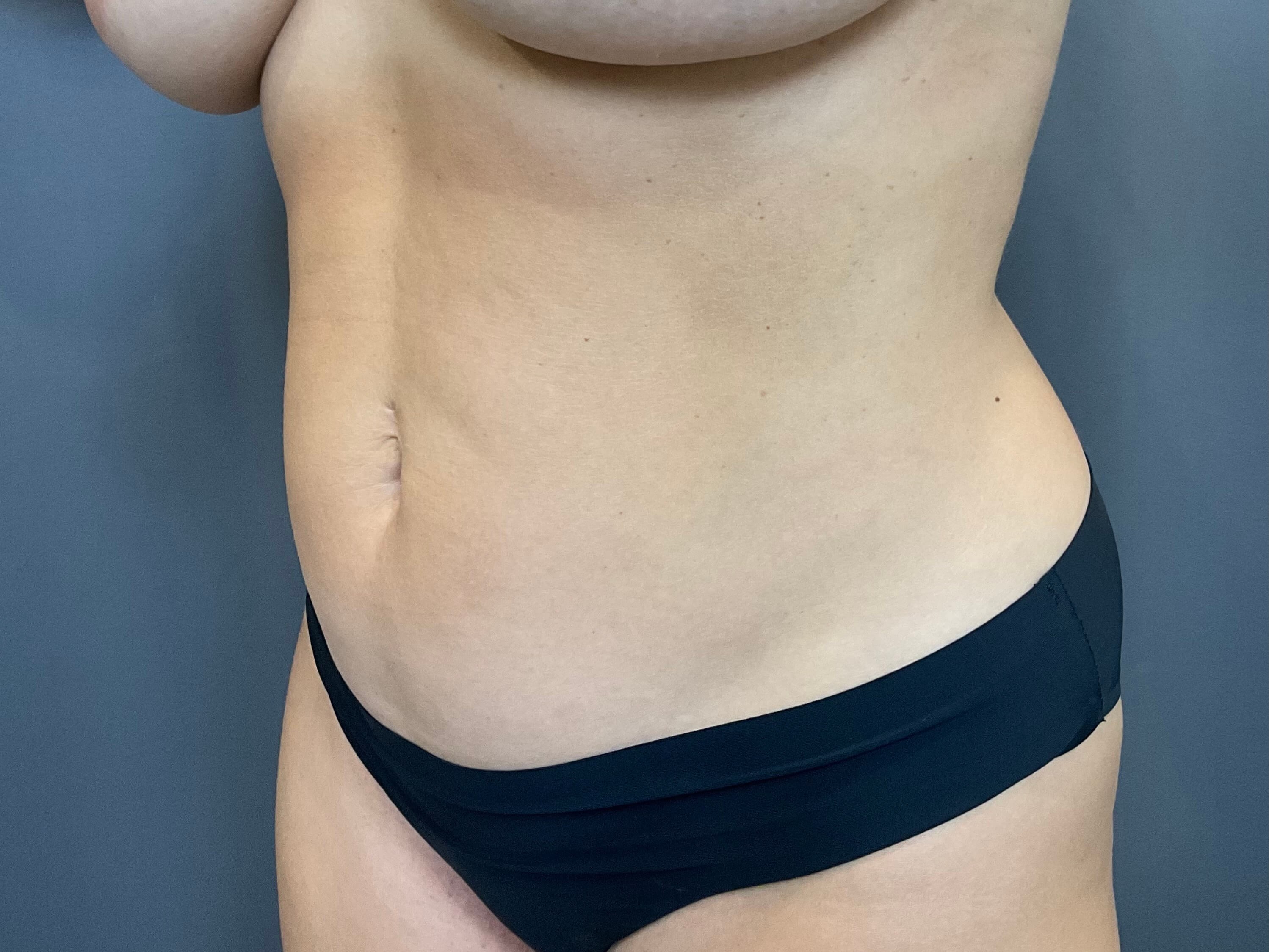 Liposuction of Abdomen,Flanks Before