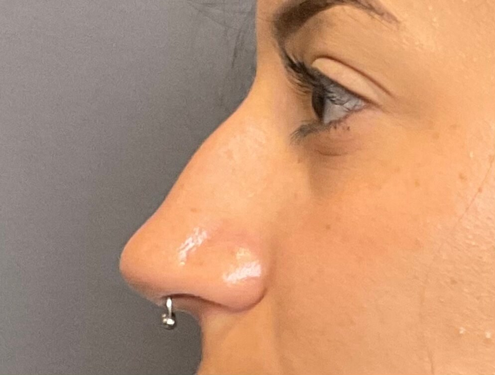 Rhinoplasty and Septoplasty Before