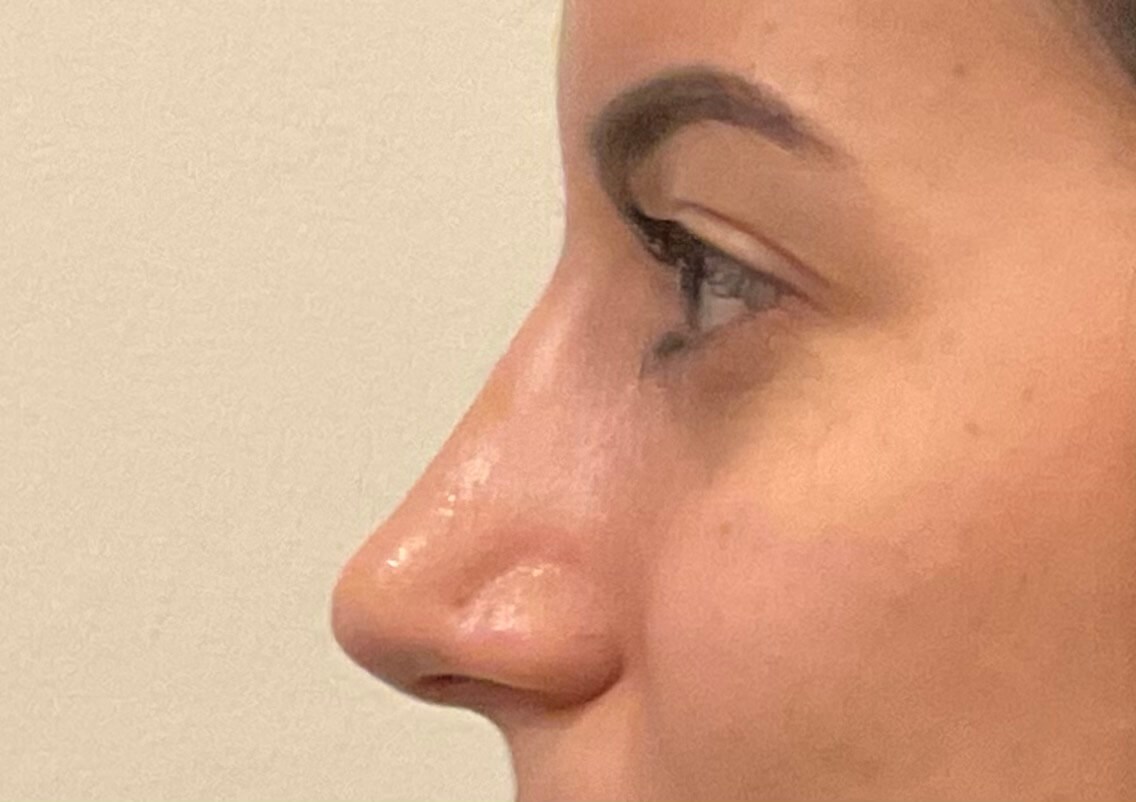 Rhinoplasty and Septoplasty After