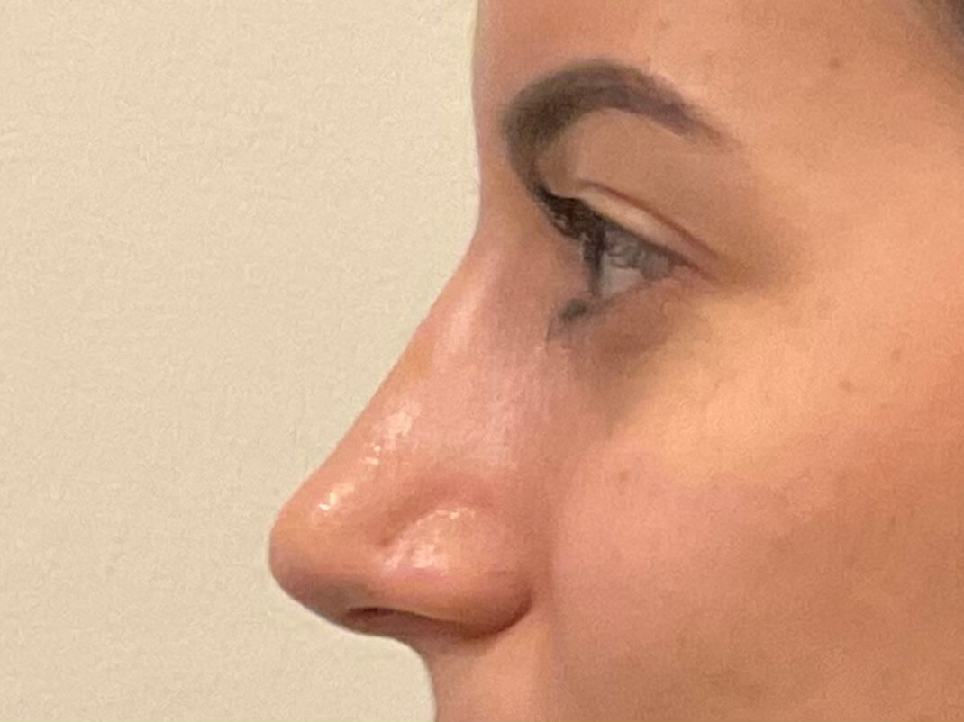 Rhinoplasty and Septoplasty After