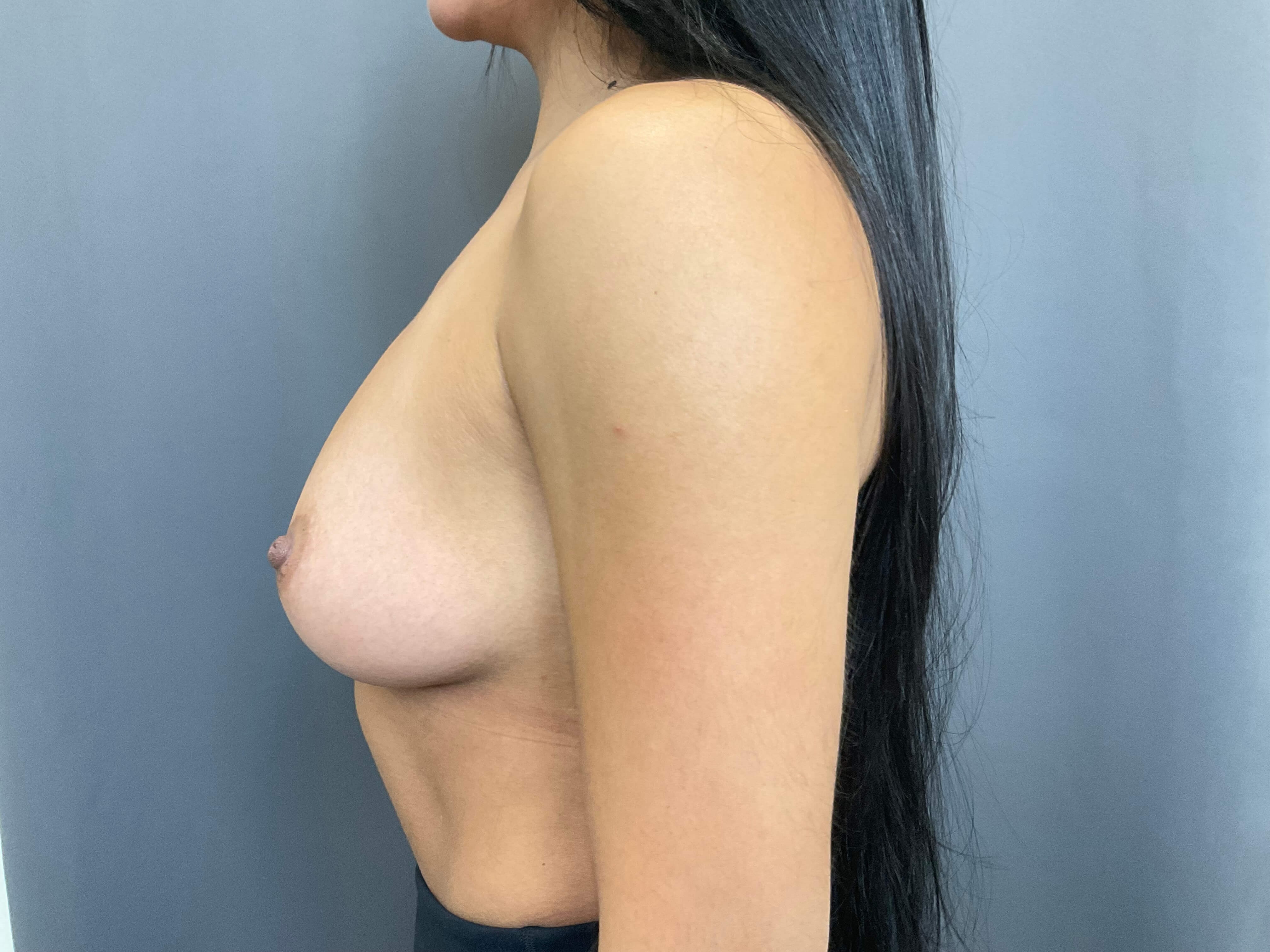 Breast Augmentation Before