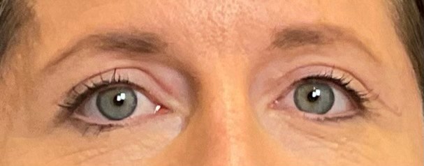Upper Blepharoplasty After