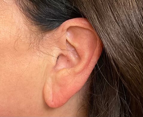 Earlobe Reduction Before