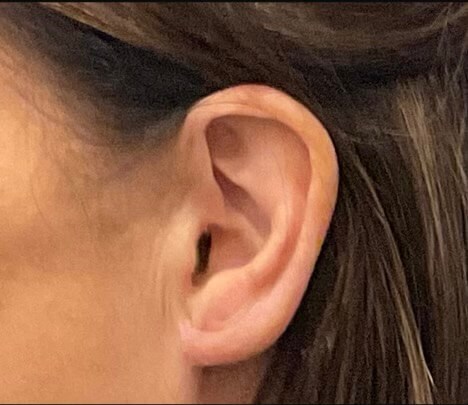 Earlobe Reduction After