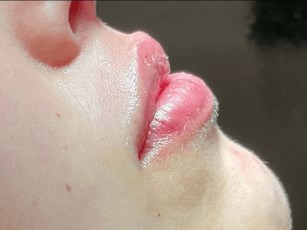 Lip Filler After