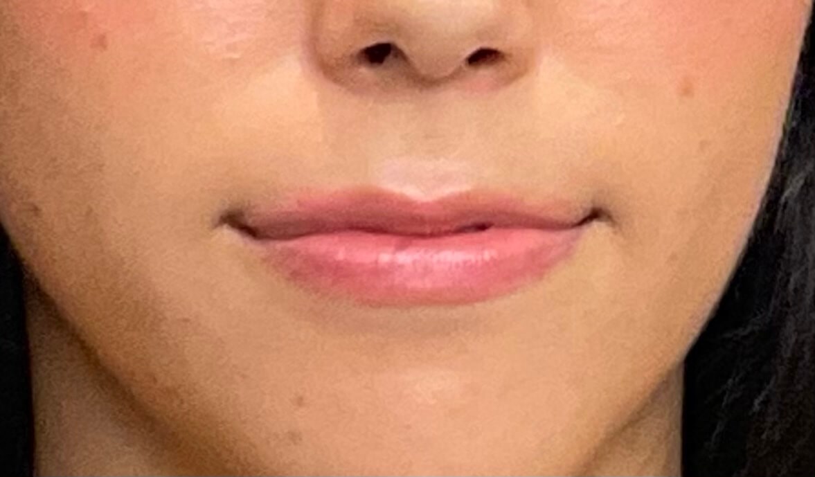 Lip Filler - Restylane Kysse Before