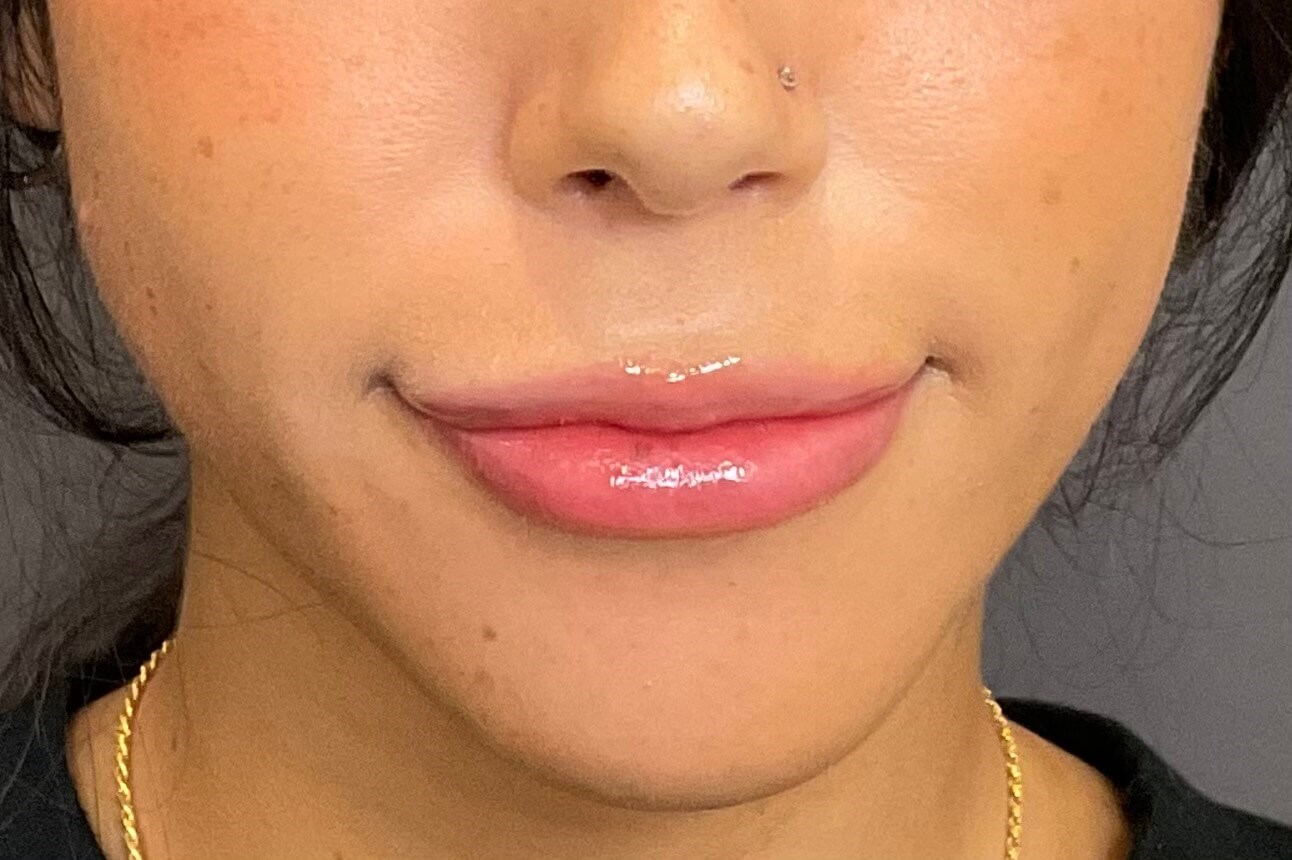 Lip Filler - Restylane Kysse After
