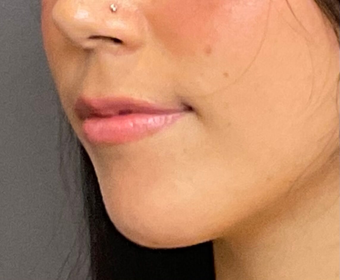 Lip Filler- Restylane Kysse Before
