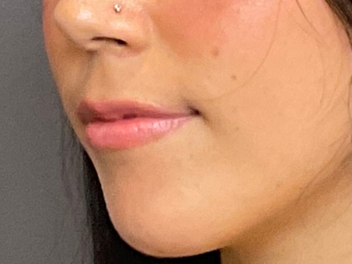 Lip Filler- Restylane Kysse Before