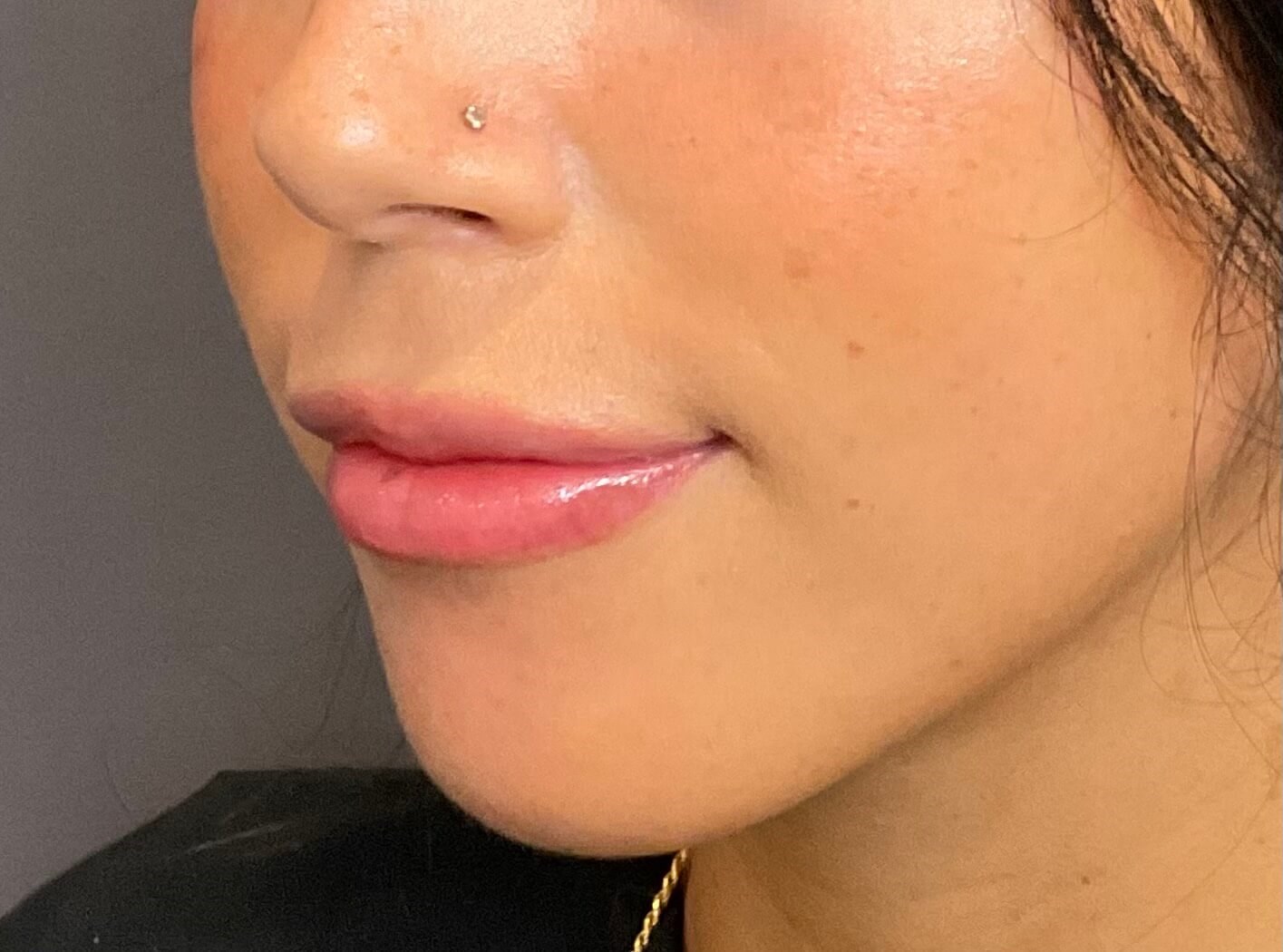 Lip Filler- Restylane Kysse After