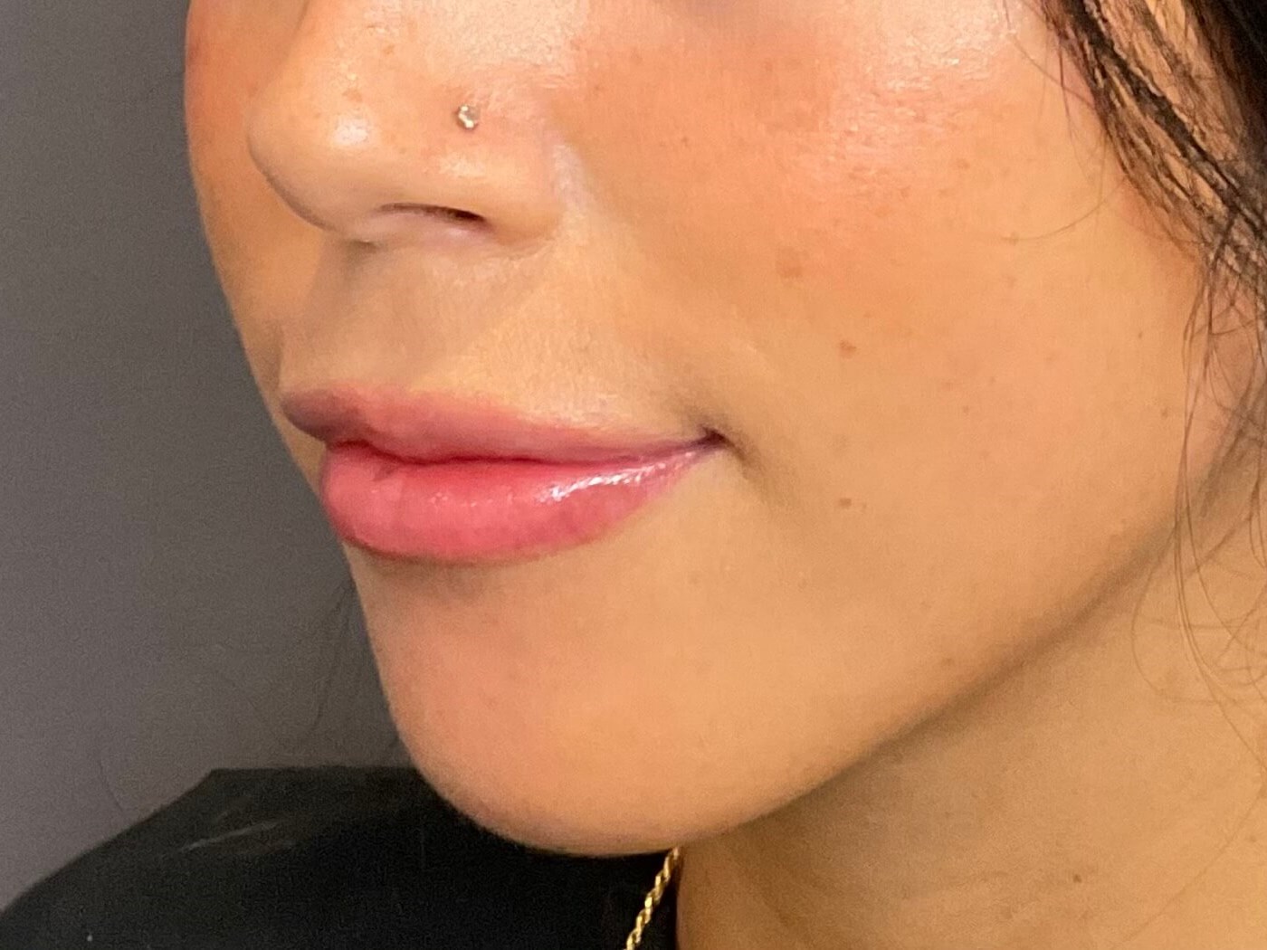 Lip Filler- Restylane Kysse After