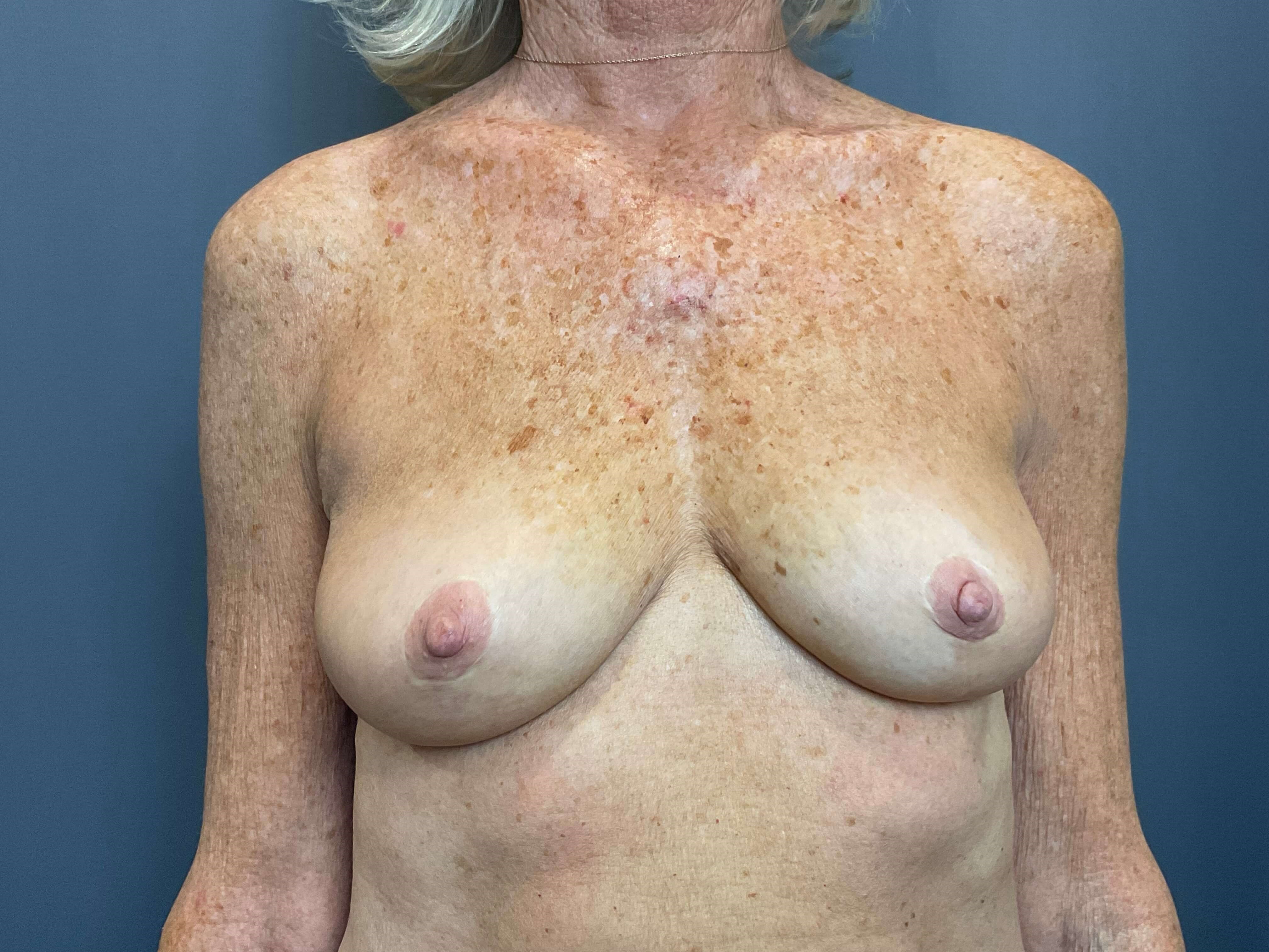 Breast Augmentation Before