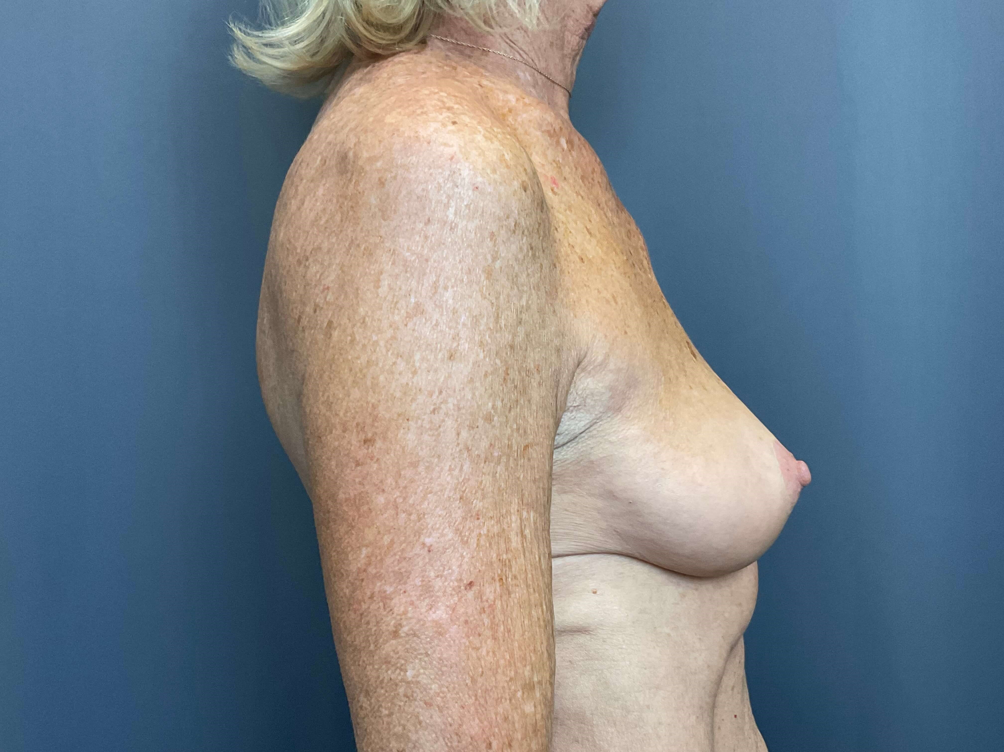 Breast Augmentation Before