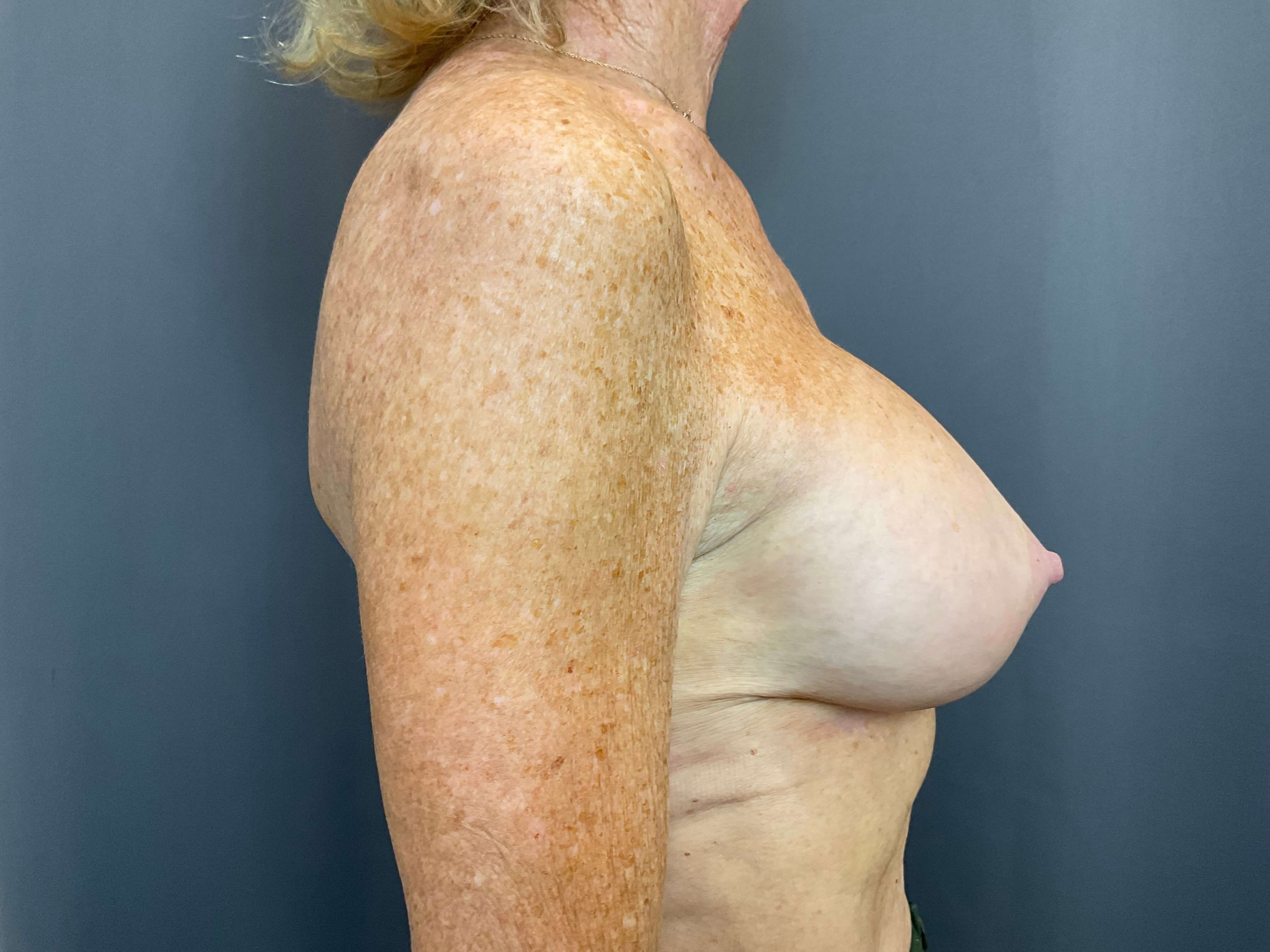 Breast Augmentation After
