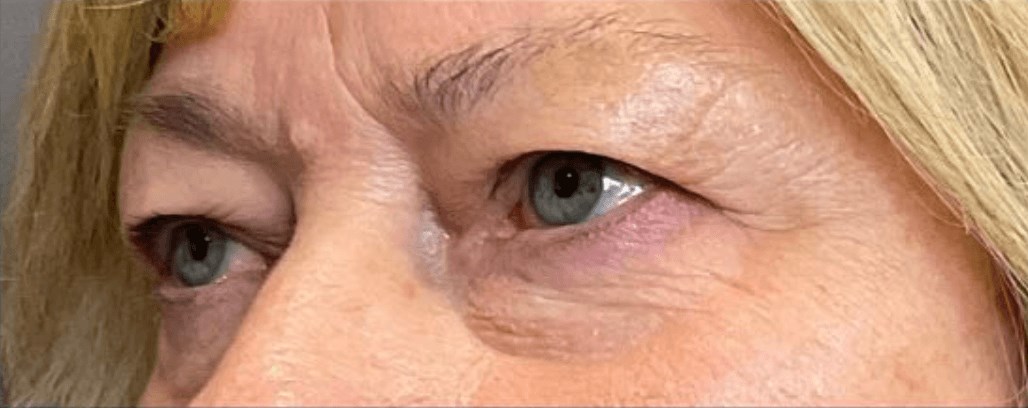 Upper Blepharoplasty Before