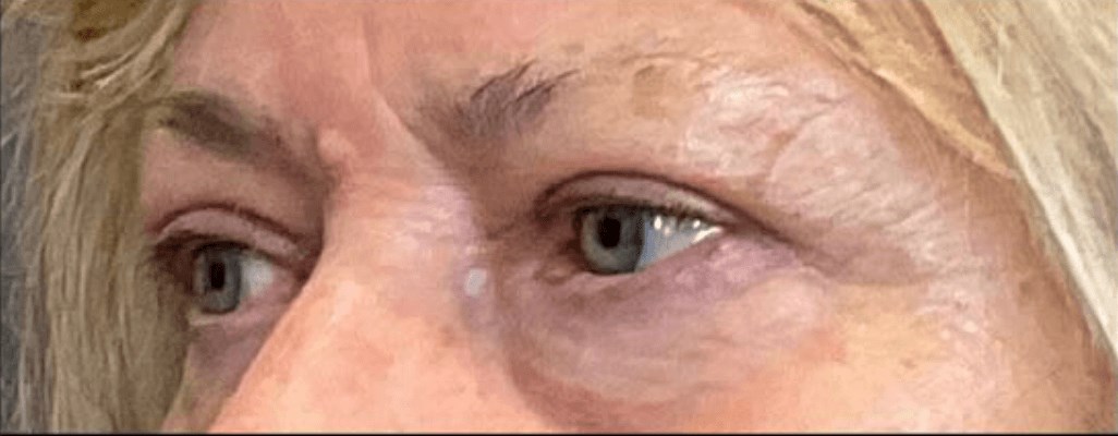 Upper Blepharoplasty After