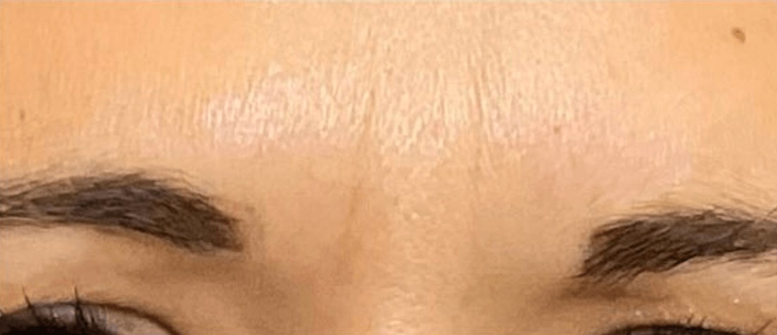 Glabella Dysport After