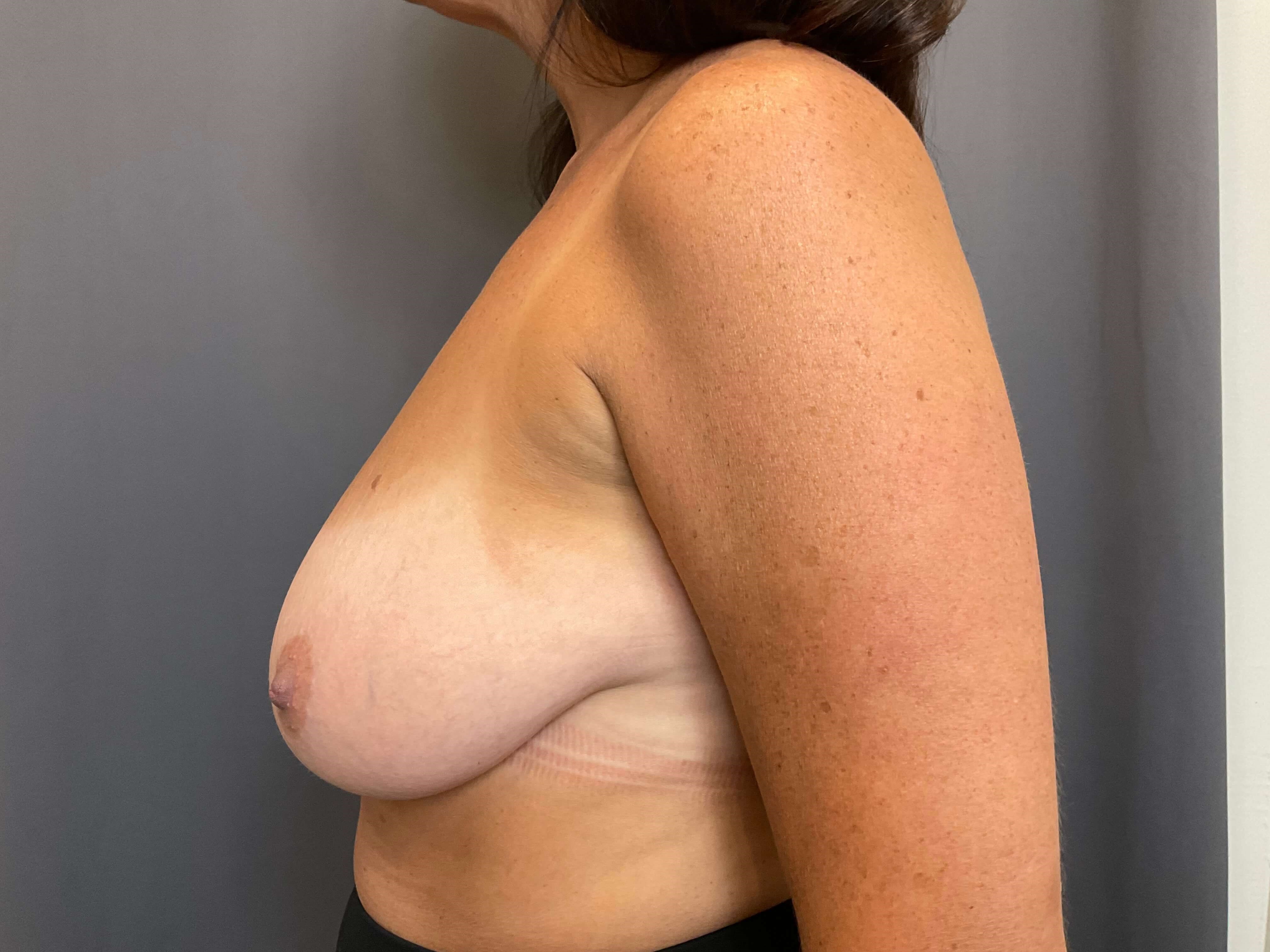 Breast Reduction Before