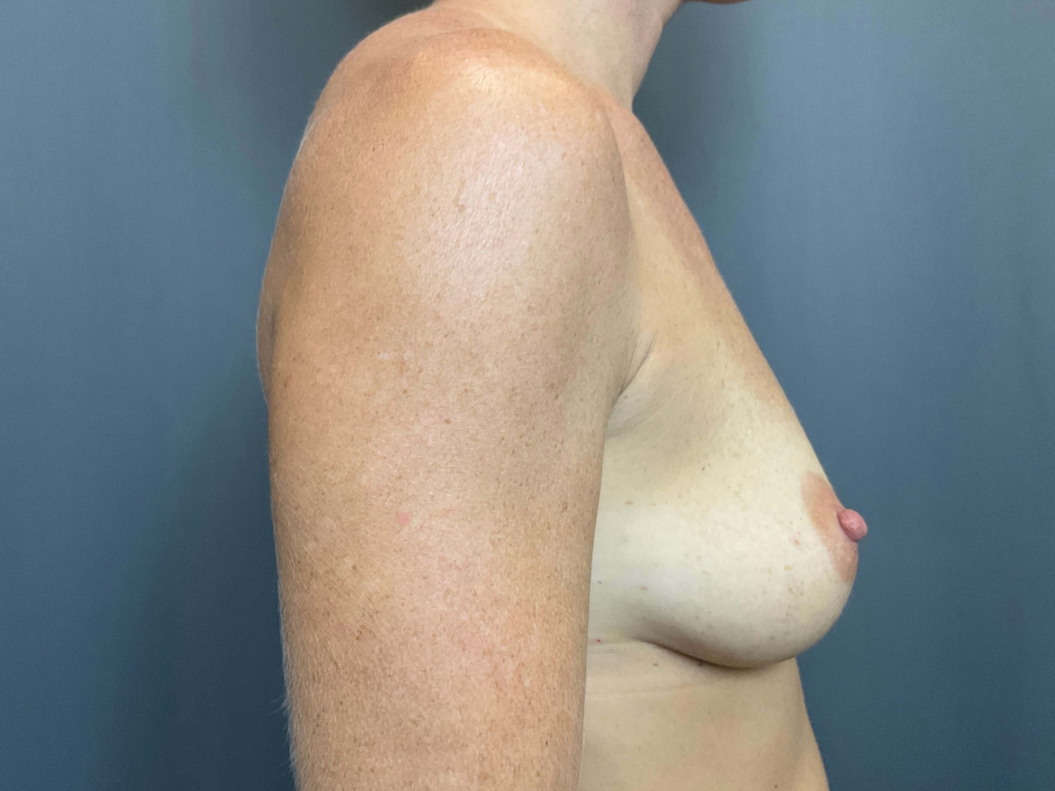 Breast Augmentation Before