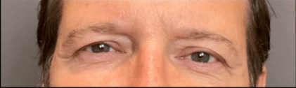 Upper Blepharoplasty Before