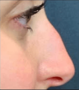 Liquid Rhinoplasty Before