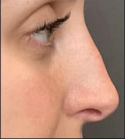 Liquid Rhinoplasty After