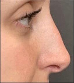 Liquid Rhinoplasty After