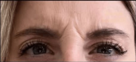 Glabella Dysport Before