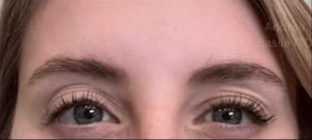 Glabella Dysport After