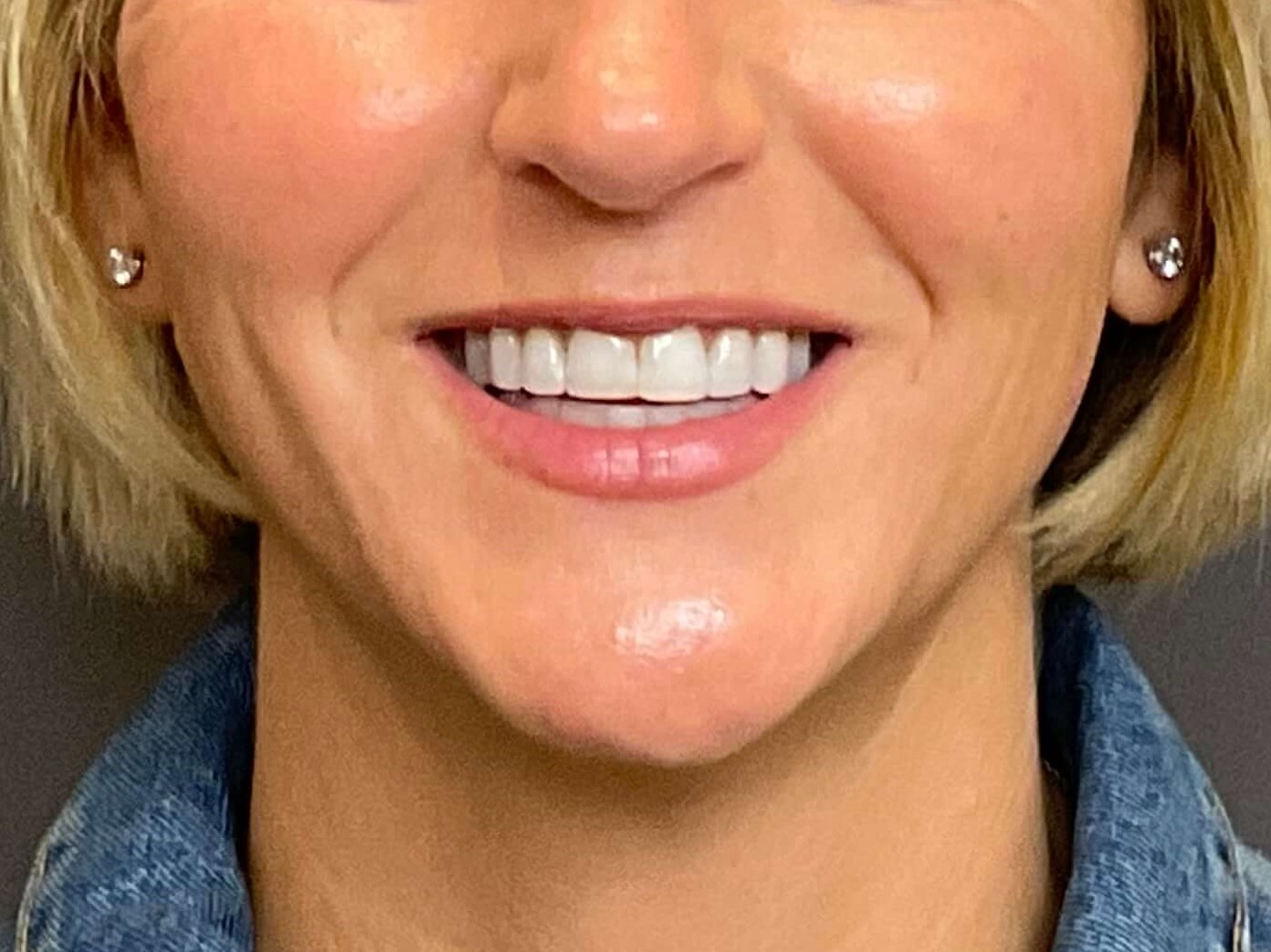 Lip Filler & Lip Flip Before