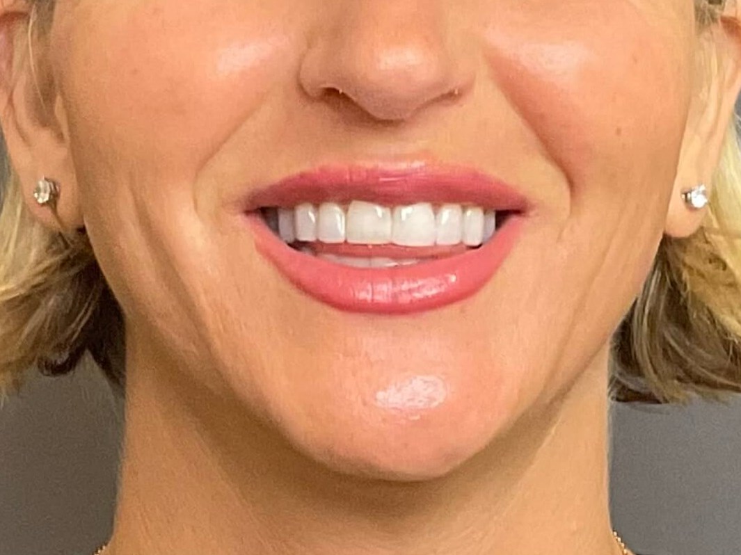 Lip Filler & Lip Flip After
