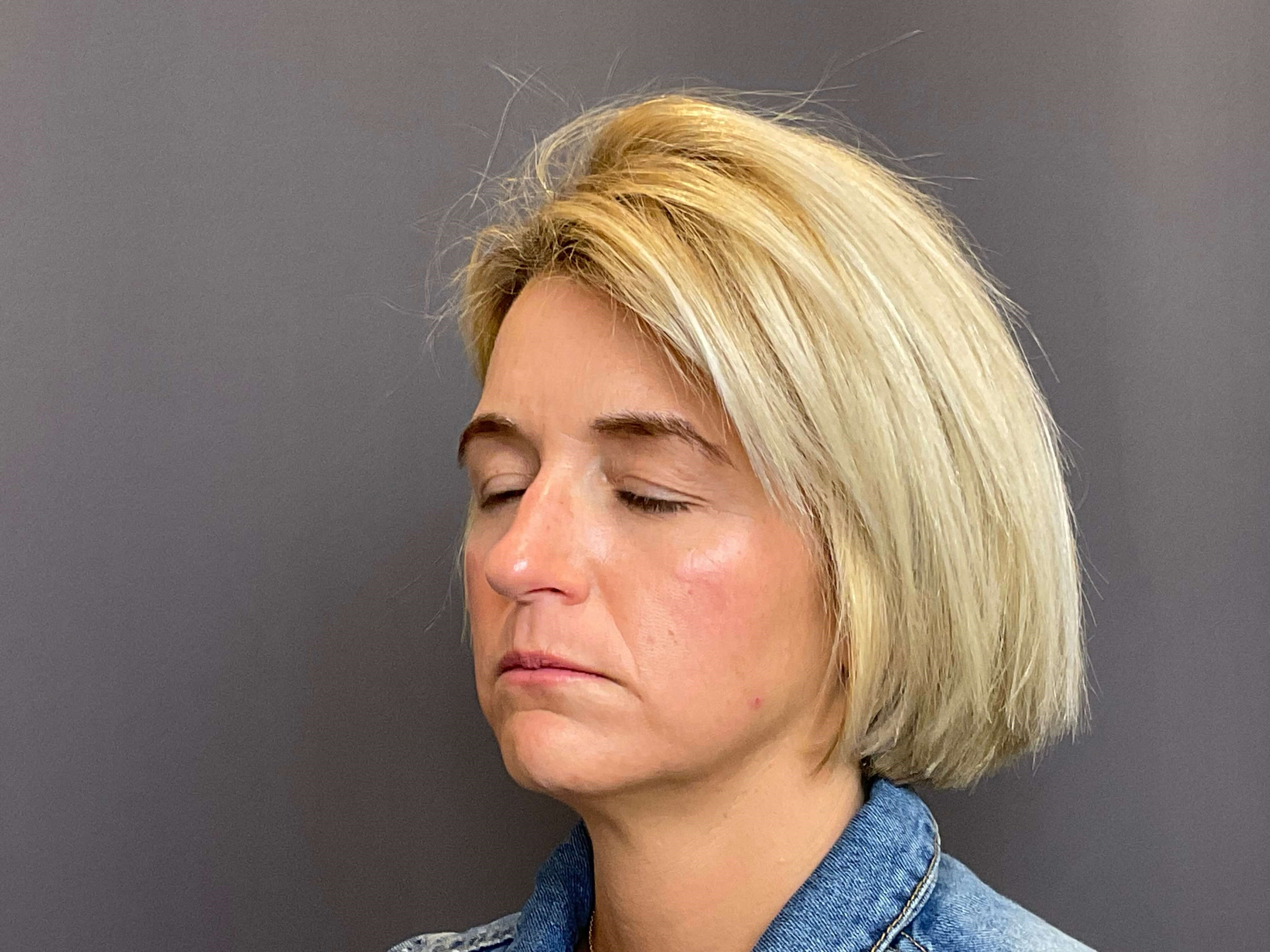 Lip Filler & Lip Flip Before