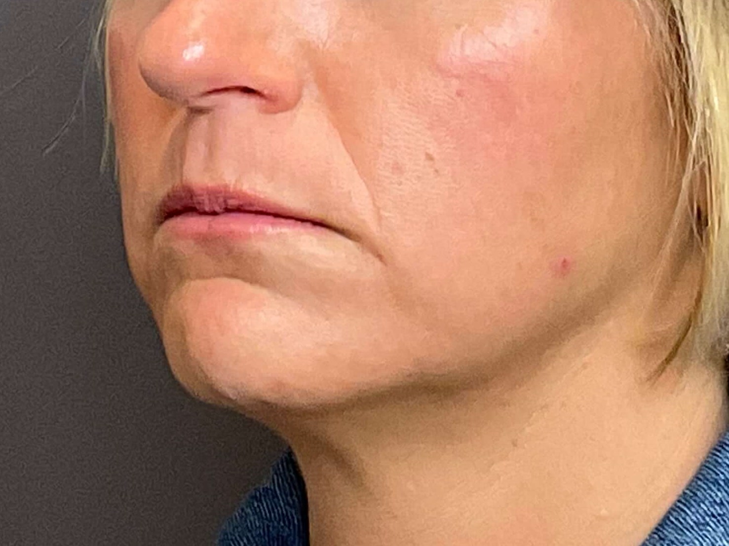 Lip Filler & Lip Flip Before