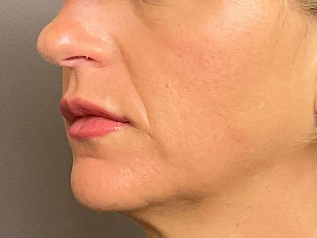 Lip Filler & Lip Flip After