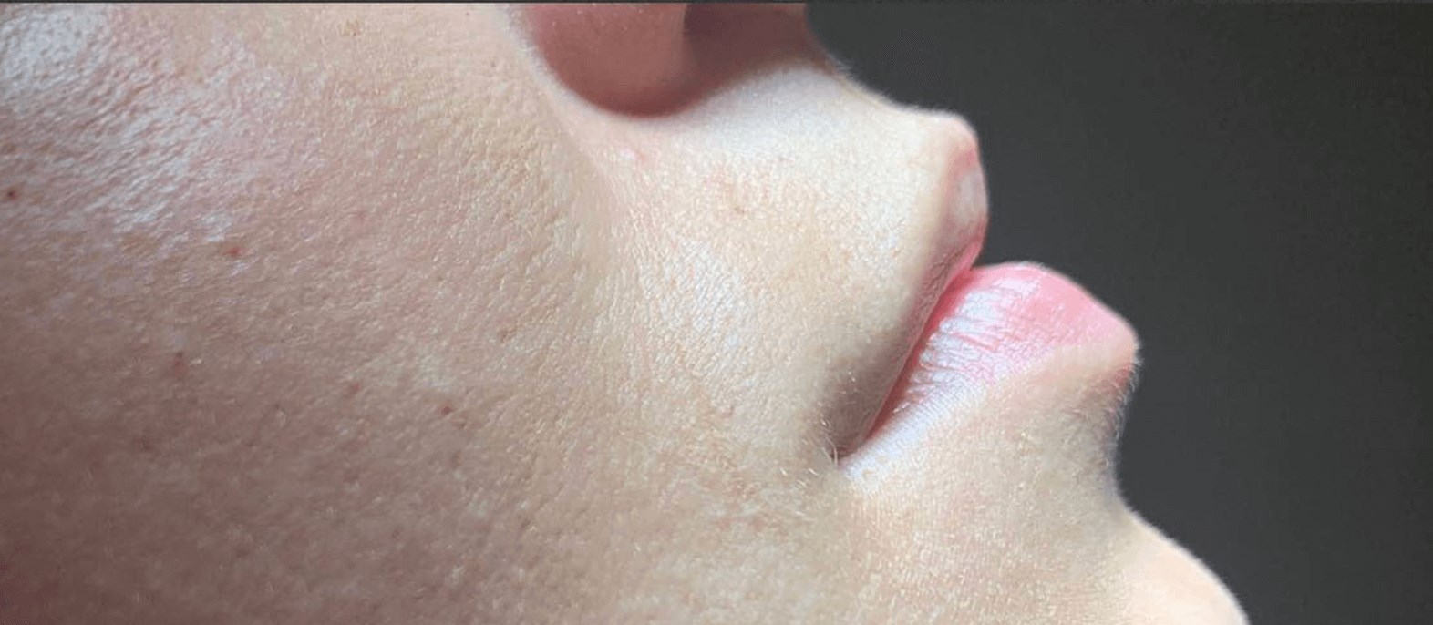 Lip Filler Before