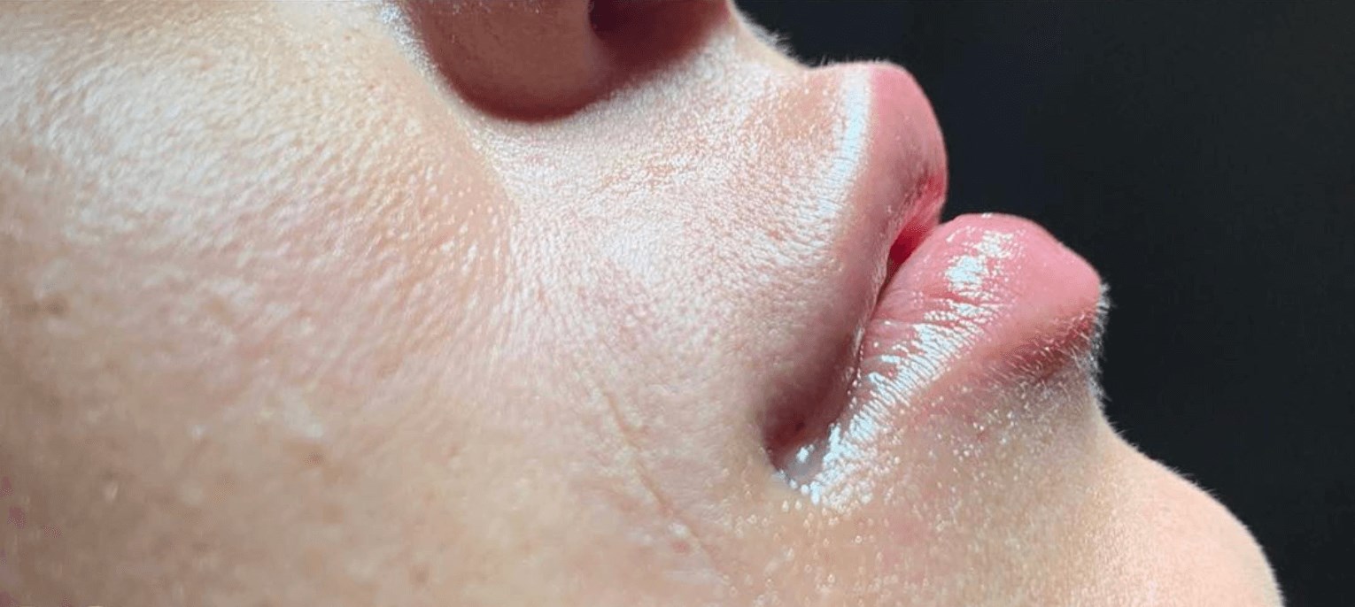 Lip Filler After