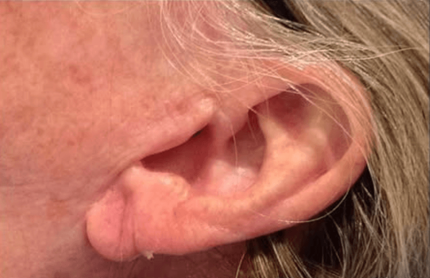 Earlobe Filler Before