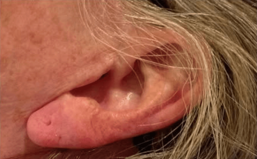 Earlobe Filler After