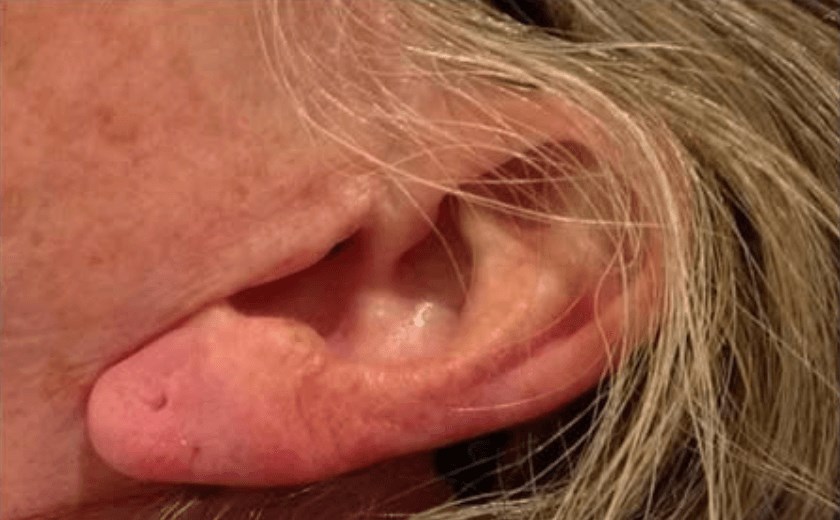 Earlobe Filler After
