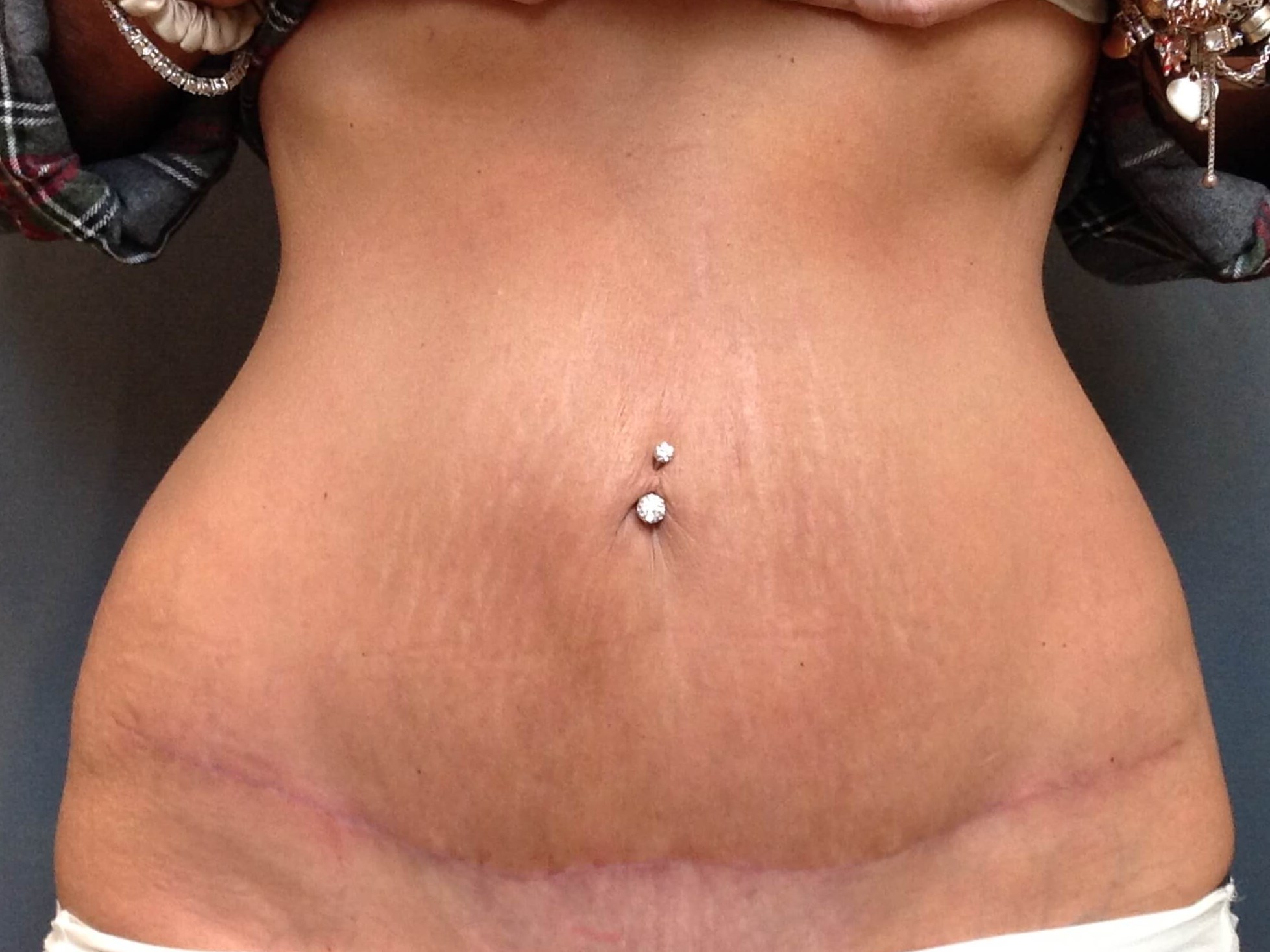 Tummy Tuck After