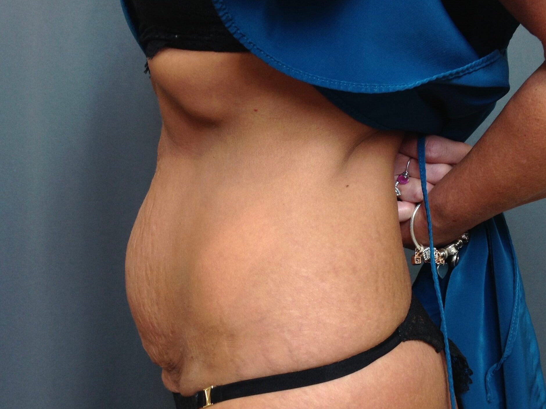 Tummy Tuck Before