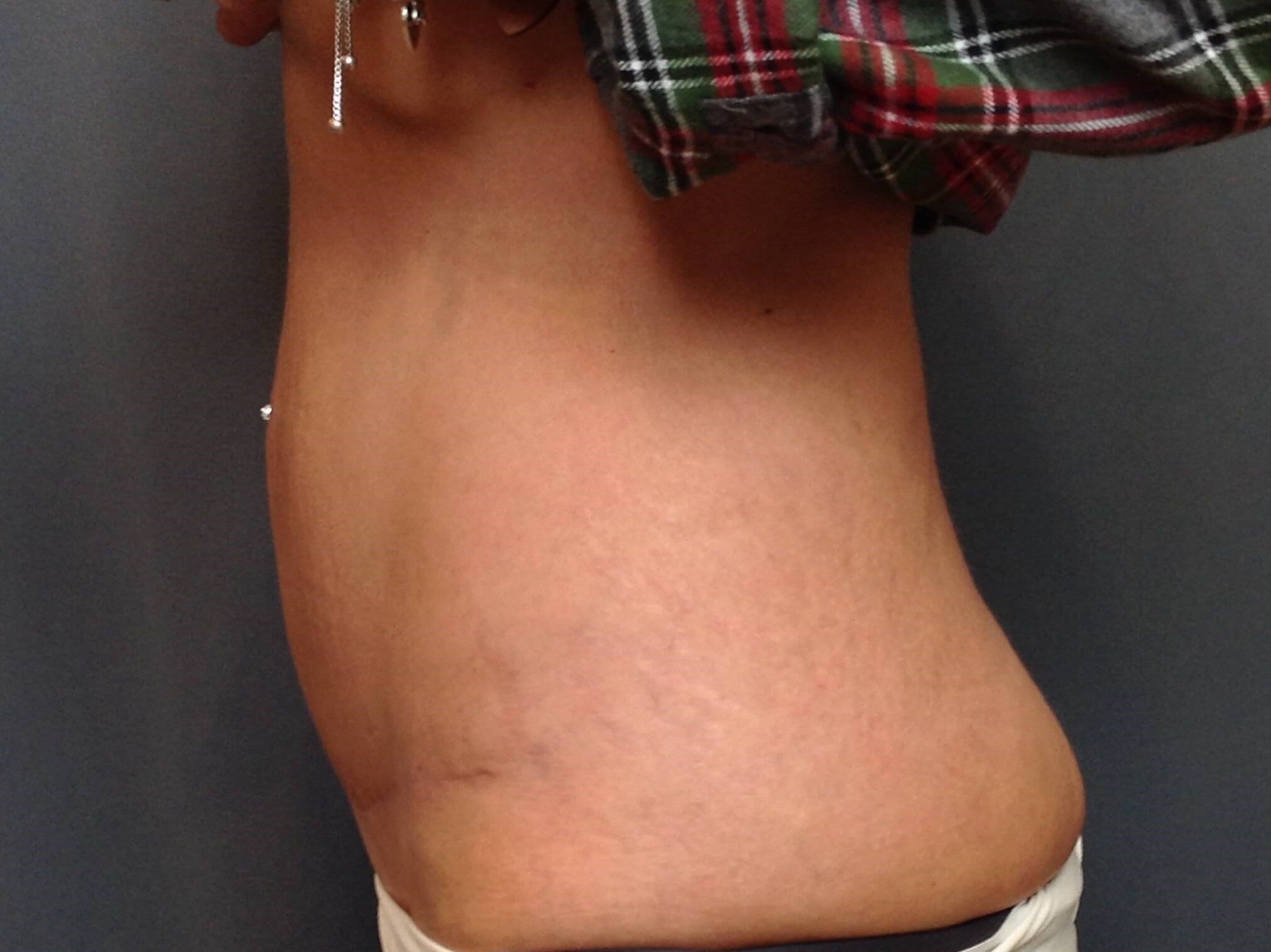 Tummy Tuck After