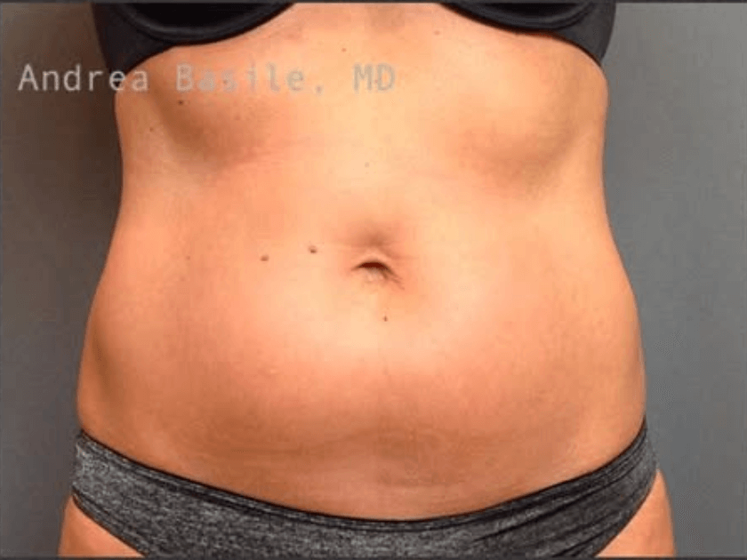 Liposuction Before