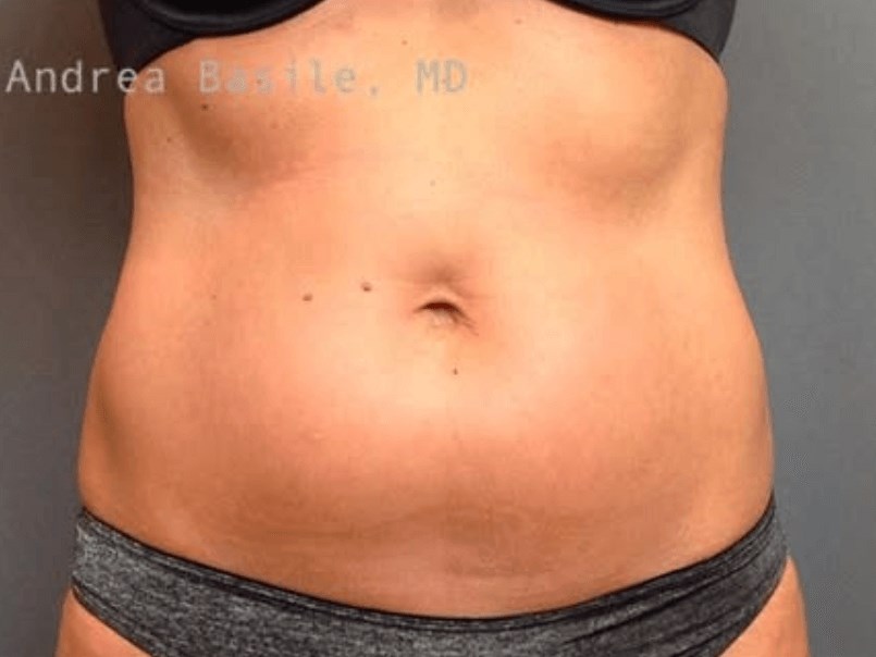 Liposuction Before