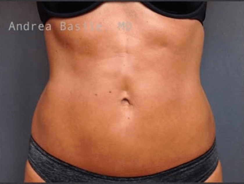 Liposuction After