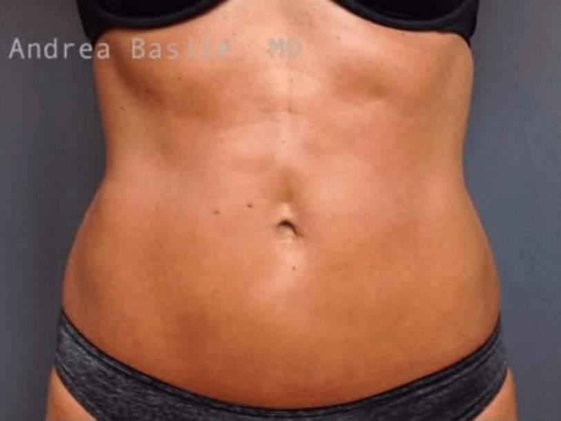 Liposuction After