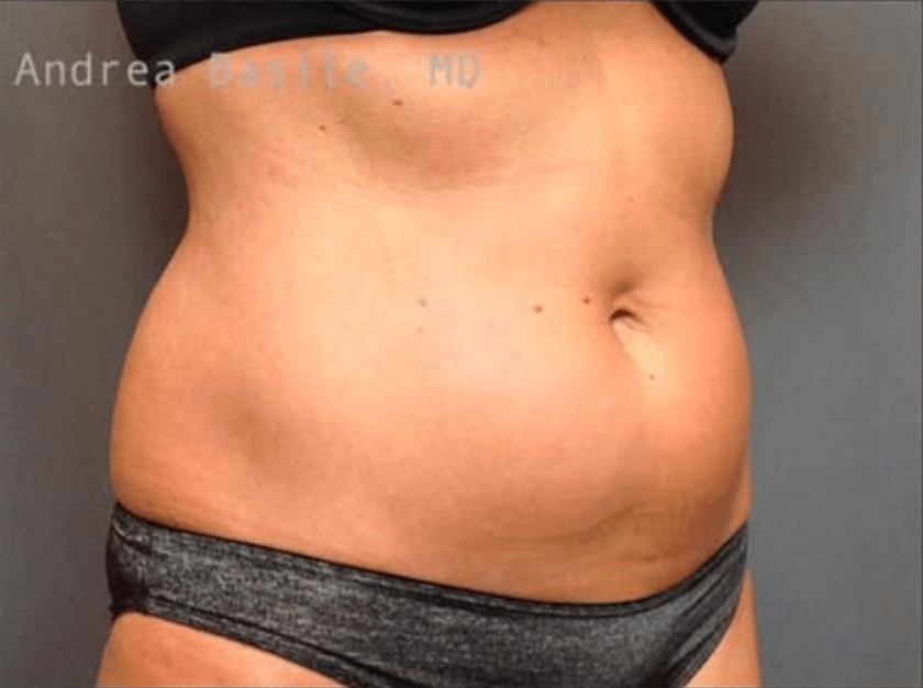 Liposuction Before
